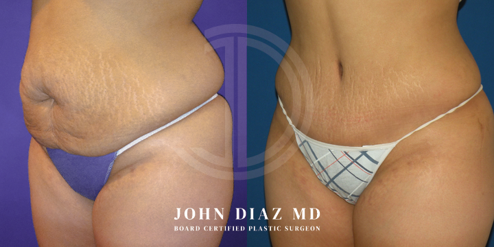 Dr John Diaz Before and After | Tummy Tuck