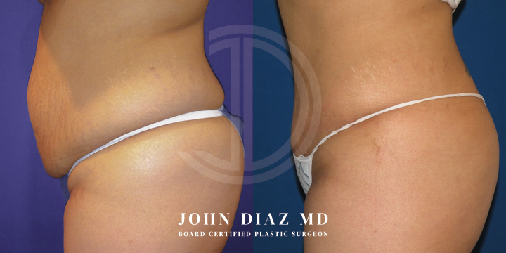 Dr John Diaz Before and After | Tummy Tuck