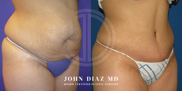 Dr John Diaz Before and After | Tummy Tuck