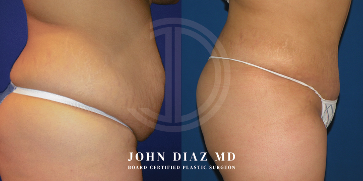 Dr John Diaz Before and After | Tummy Tuck