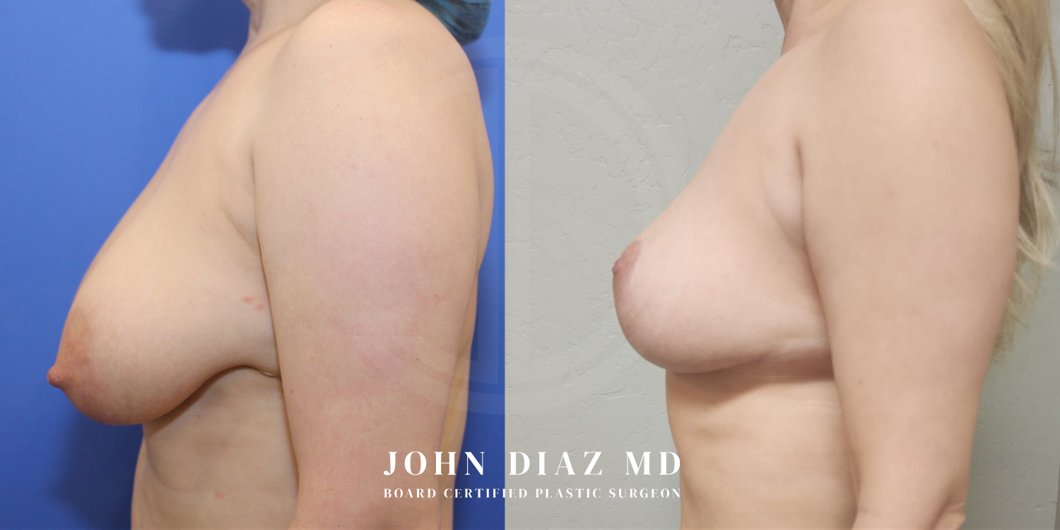 Dr John Diaz Before and After | Breast Augmentation