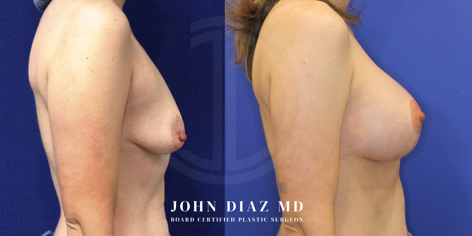 Dr John Diaz Before and After | Breast Augmentation