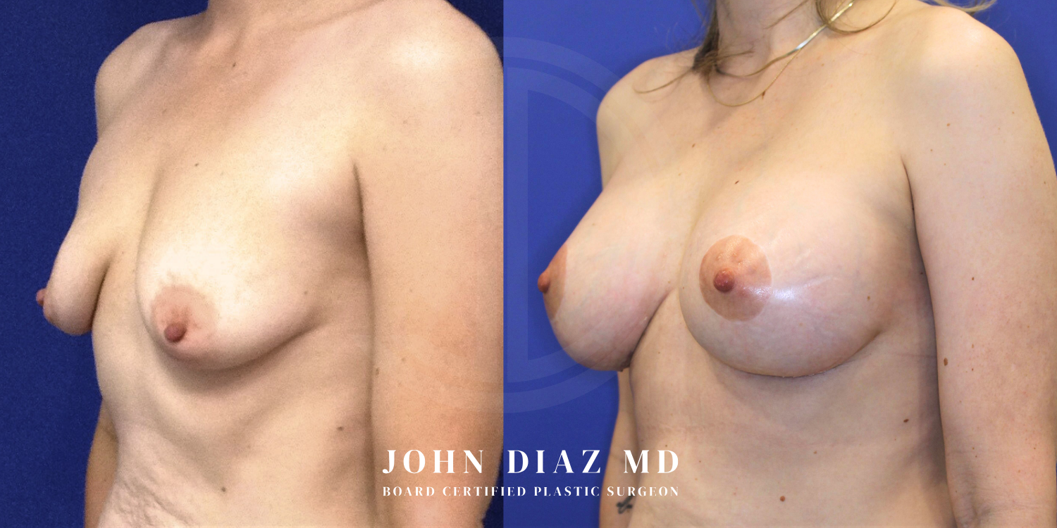 Dr John Diaz Before and After | Breast Augmentation