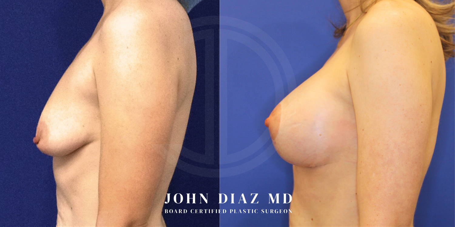 Dr John Diaz Before and After | Breast Augmentation