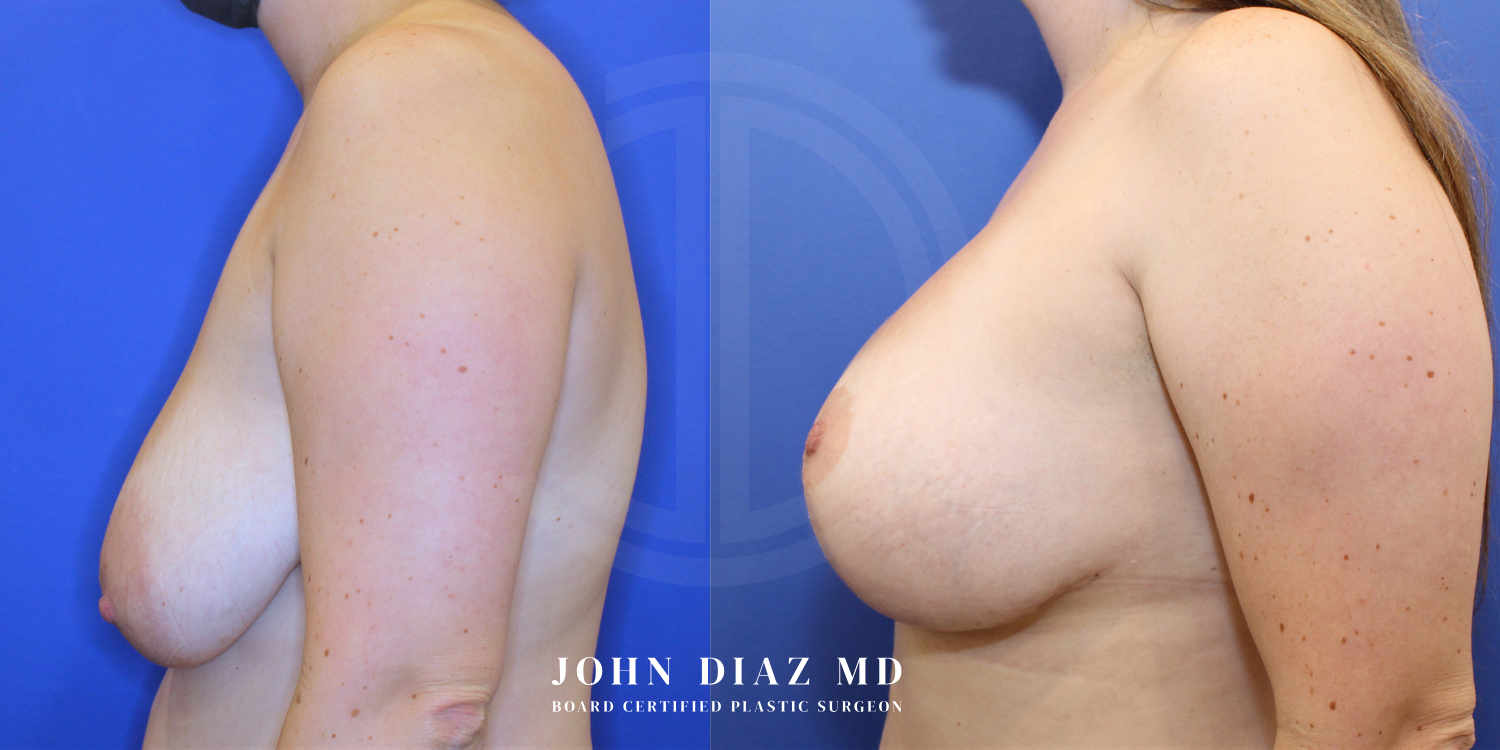 Dr John Diaz Before and After | Breast Augmentation