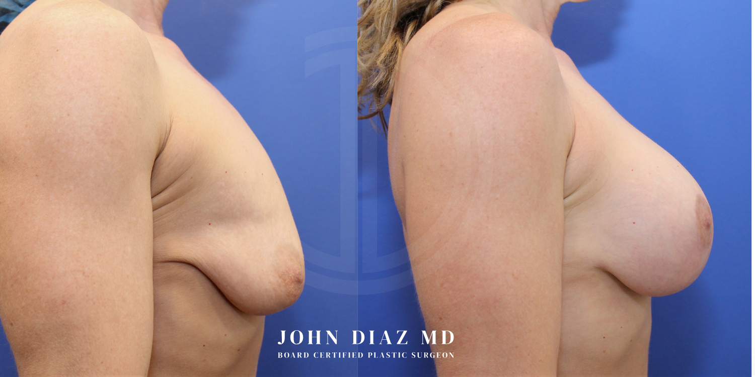 Dr John Diaz Before and After | Breast Augmentation