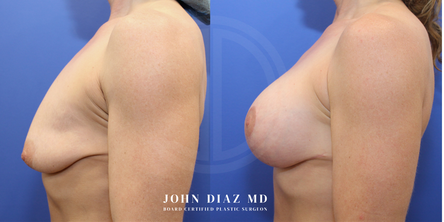 Dr John Diaz Before and After | Breast Augmentation