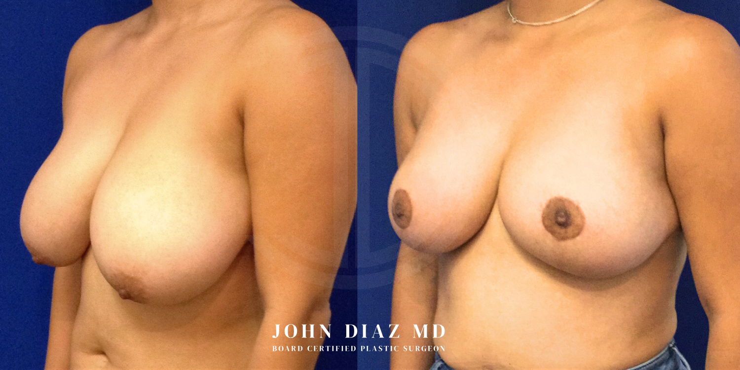 Dr John Diaz Before and After | Breast Augmentation
