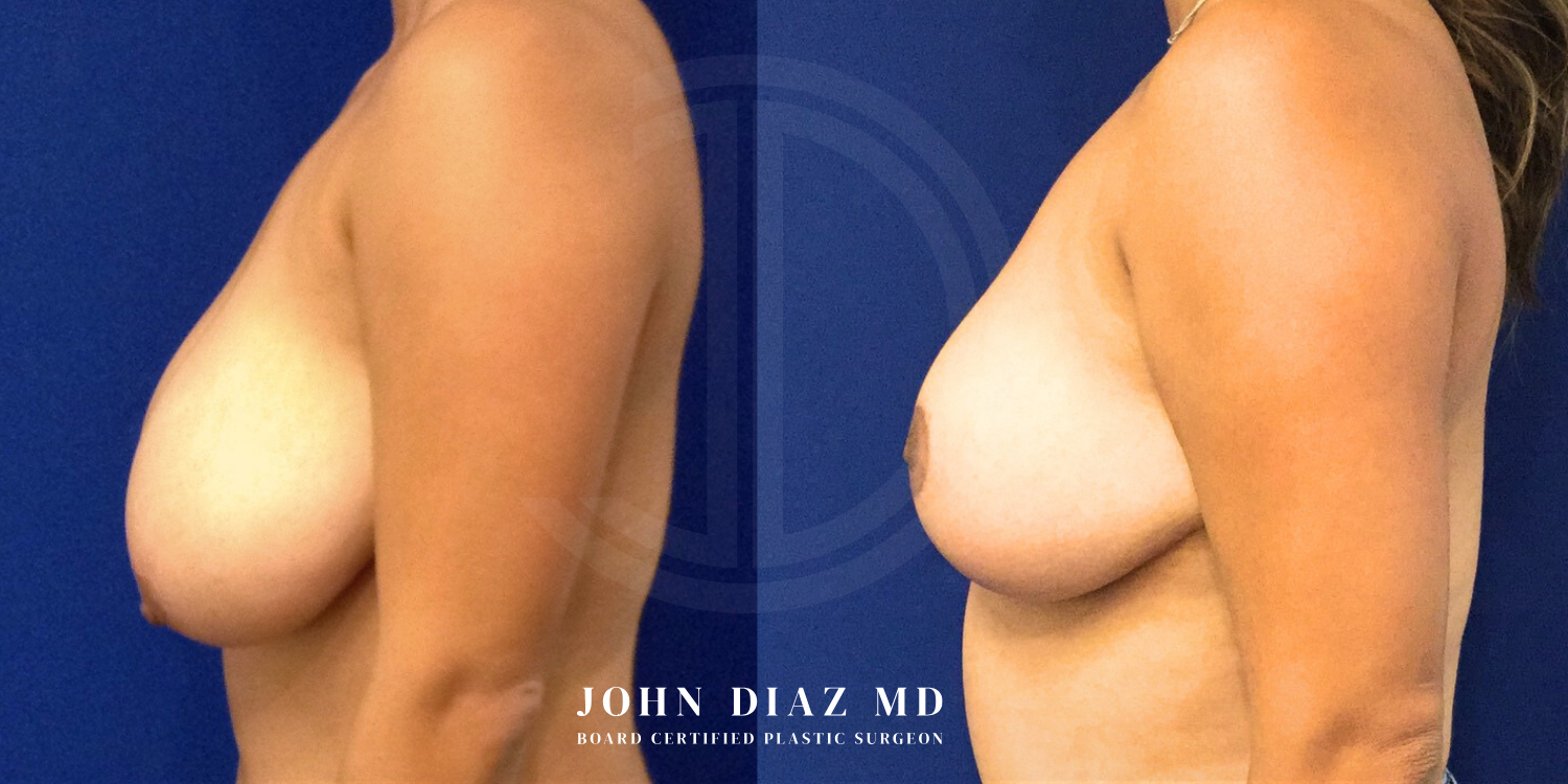 Dr John Diaz Before and After | Breast Augmentation