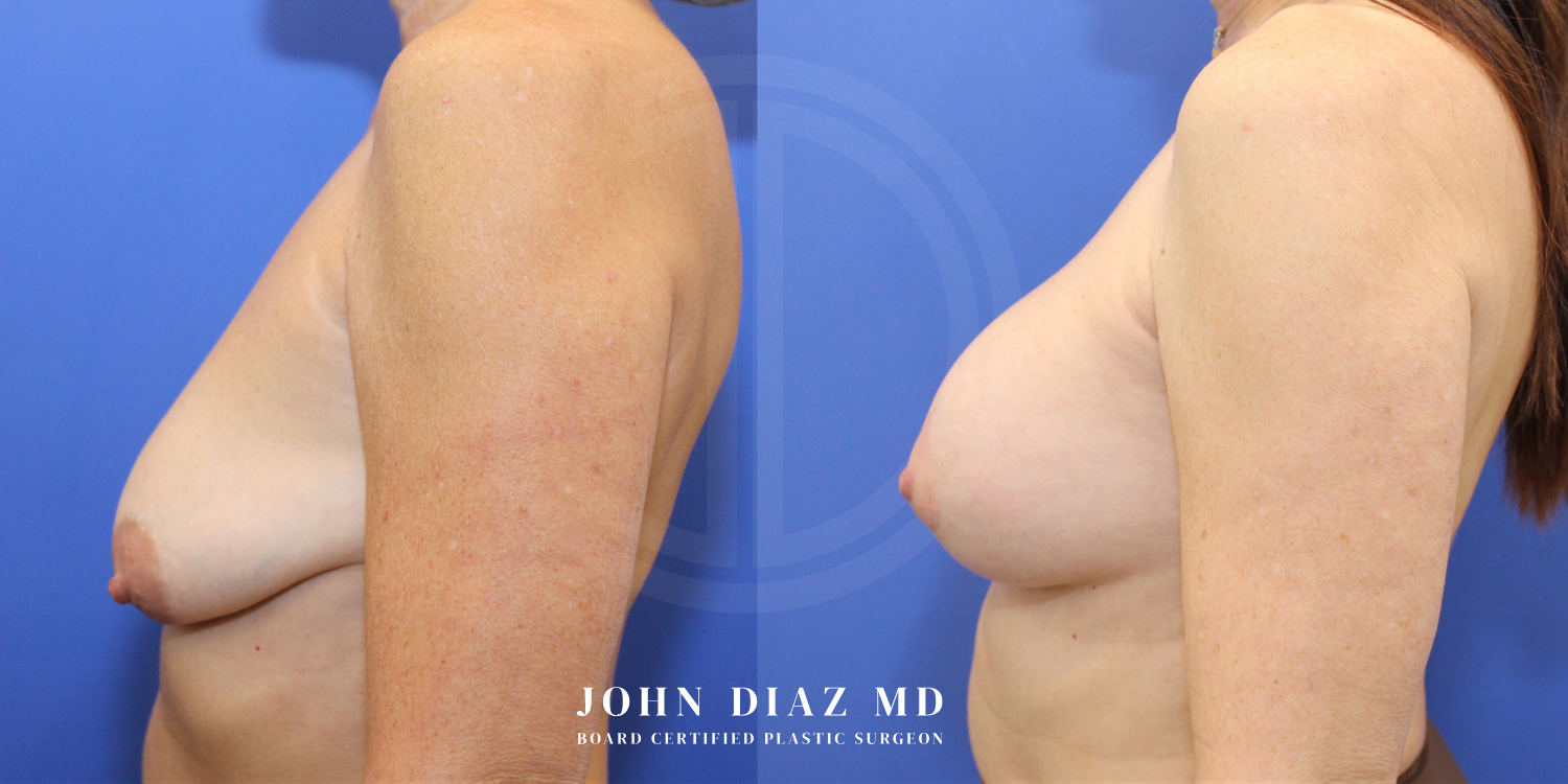 Dr John Diaz Before and After | Breast Augmentation