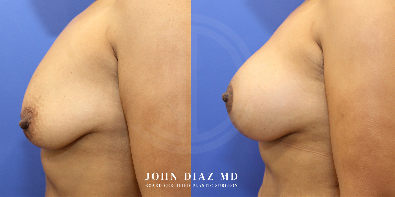 Dr John Diaz Before and After | Breast Augmentation