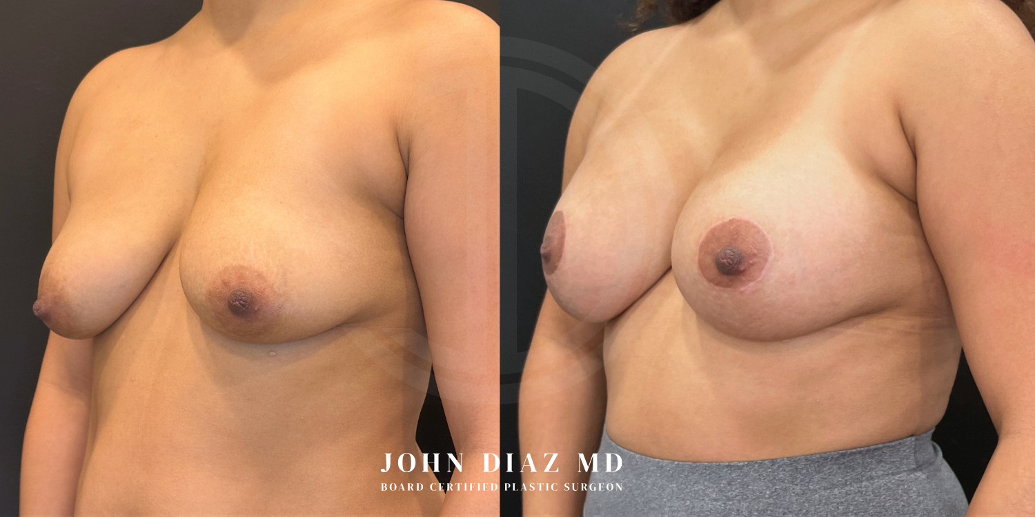 Dr John Diaz Before and After | Breast Augmentation