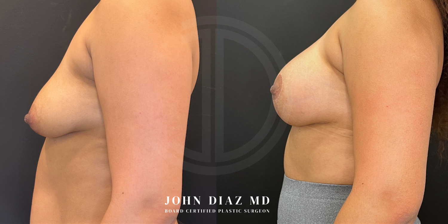 Dr John Diaz Before and After | Breast Augmentation