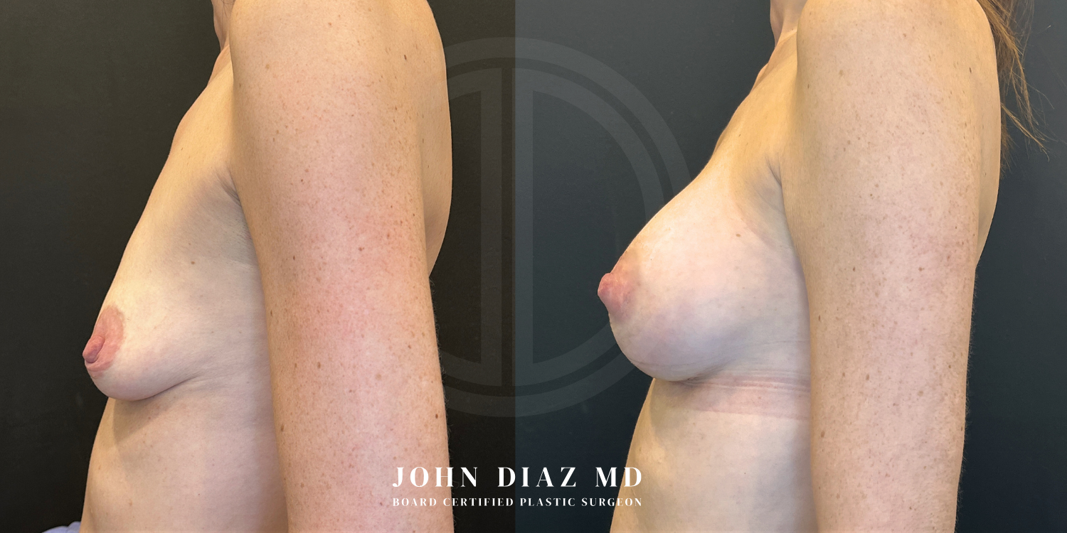 Dr John Diaz Before and After | Breast Augmentation