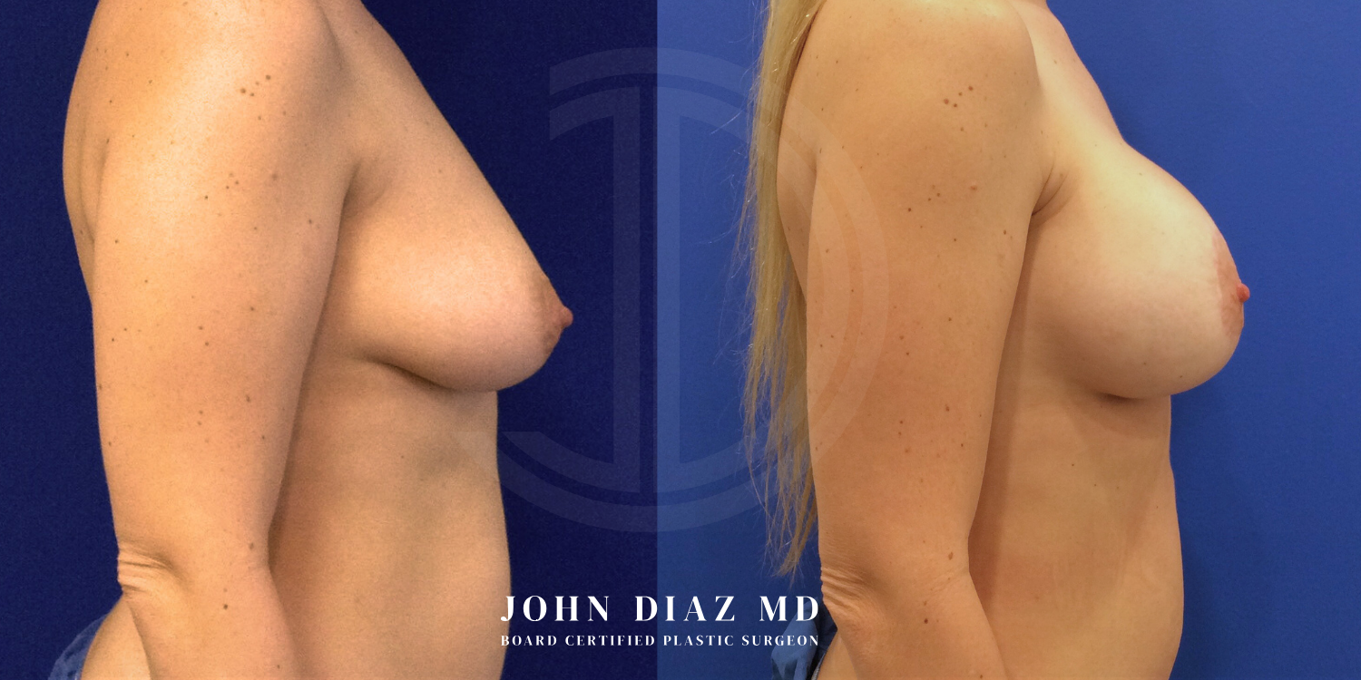 Dr John Diaz Before and After | Breast Augmentation