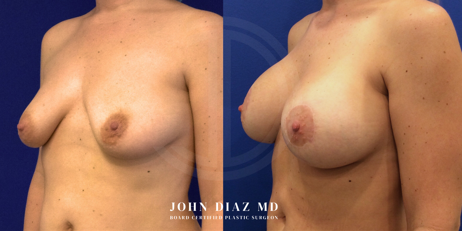 Dr John Diaz Before and After | Breast Augmentation