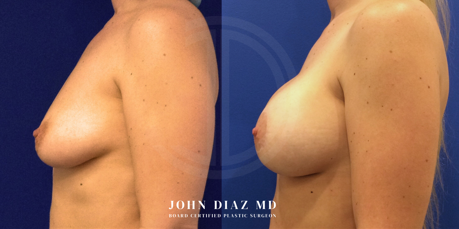 Dr John Diaz Before and After | Breast Augmentation