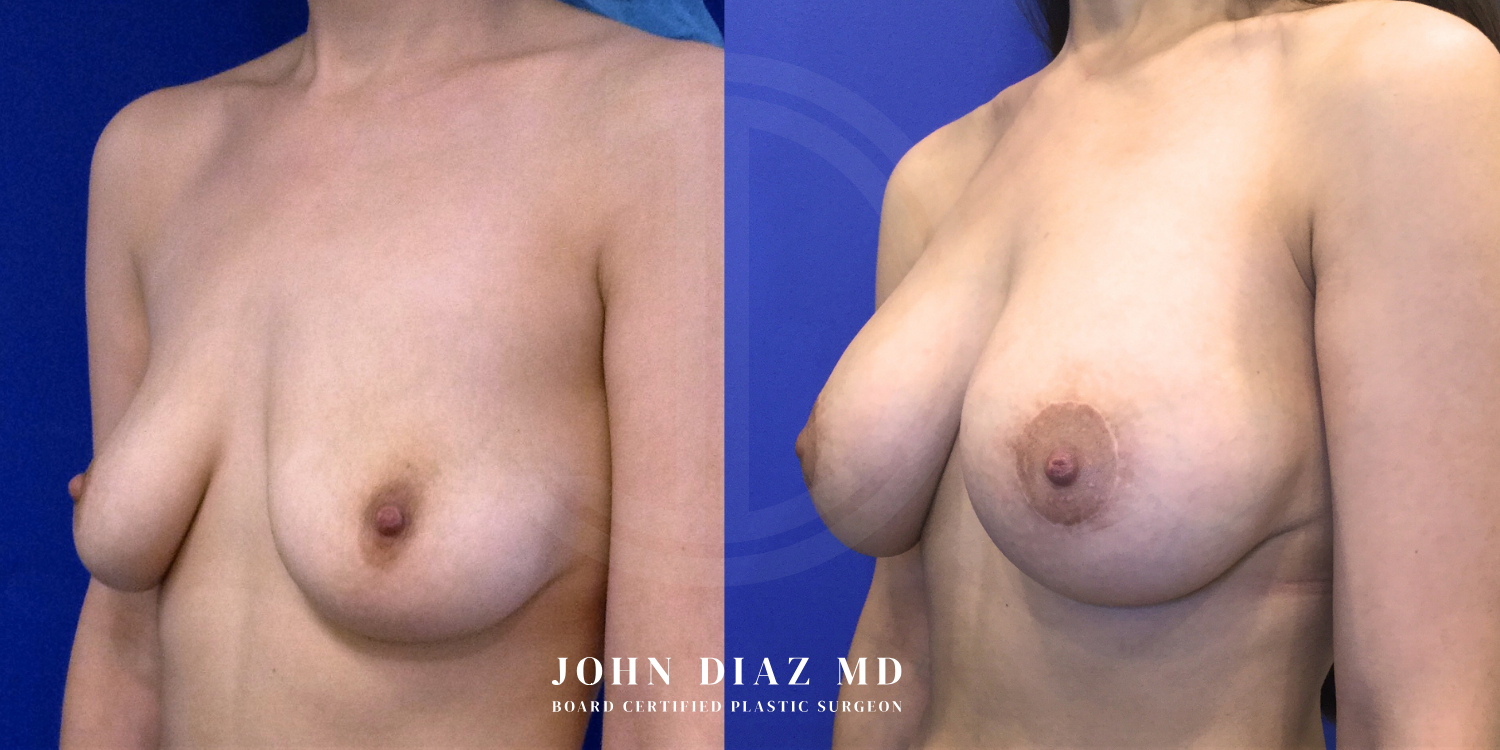 Dr John Diaz Before and After | Breast Augmentation