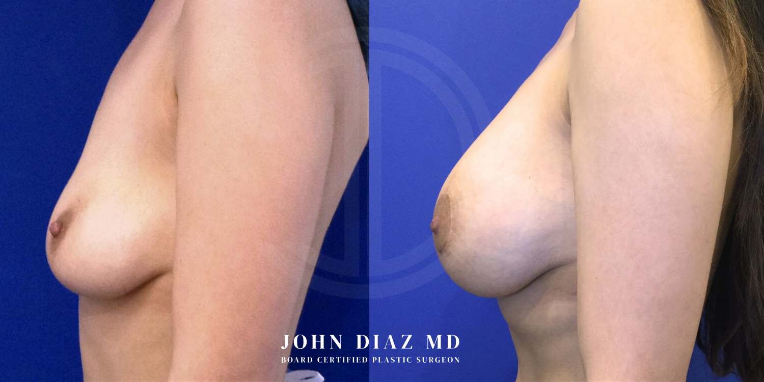 Dr John Diaz Before and After | Breast Augmentation