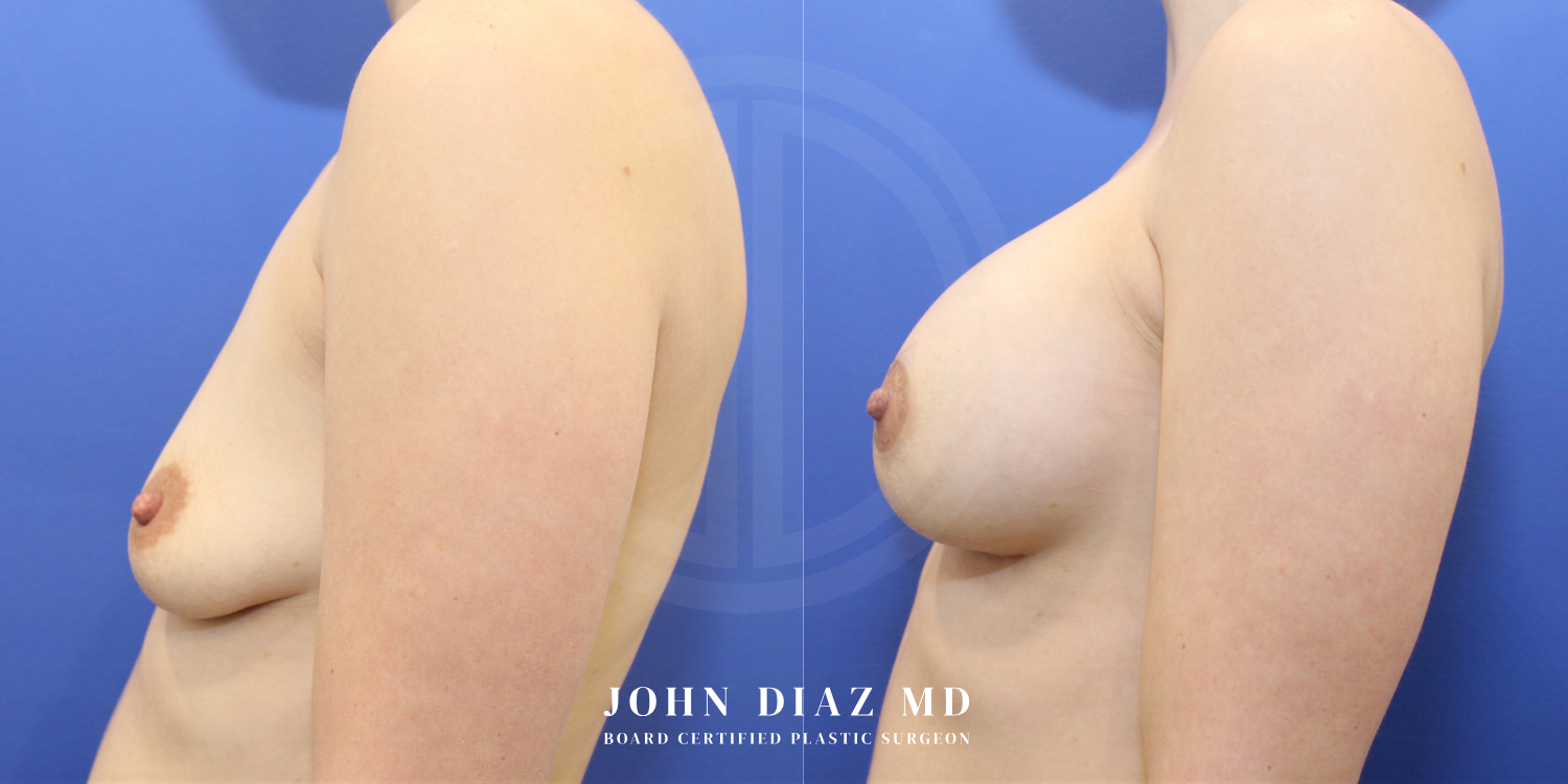 Dr John Diaz Before and After | Breast Augmentation