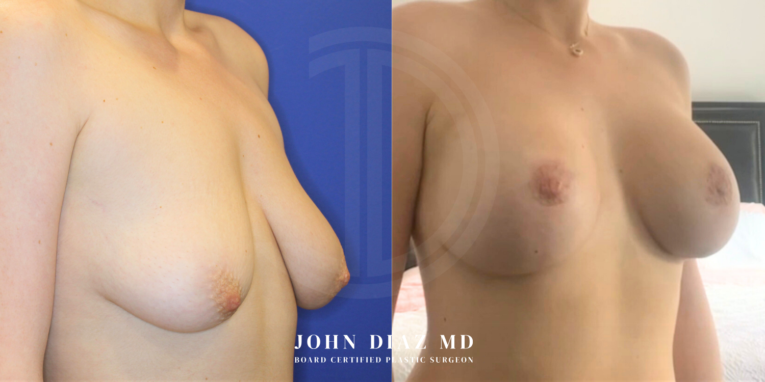 Dr John Diaz Before and After | Breast Augmentation