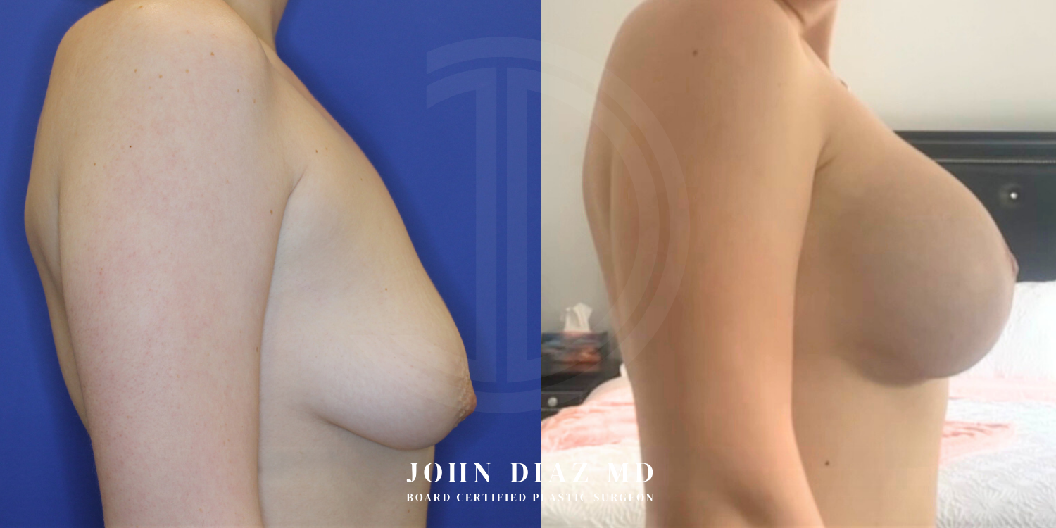 Dr John Diaz Before and After | Breast Augmentation