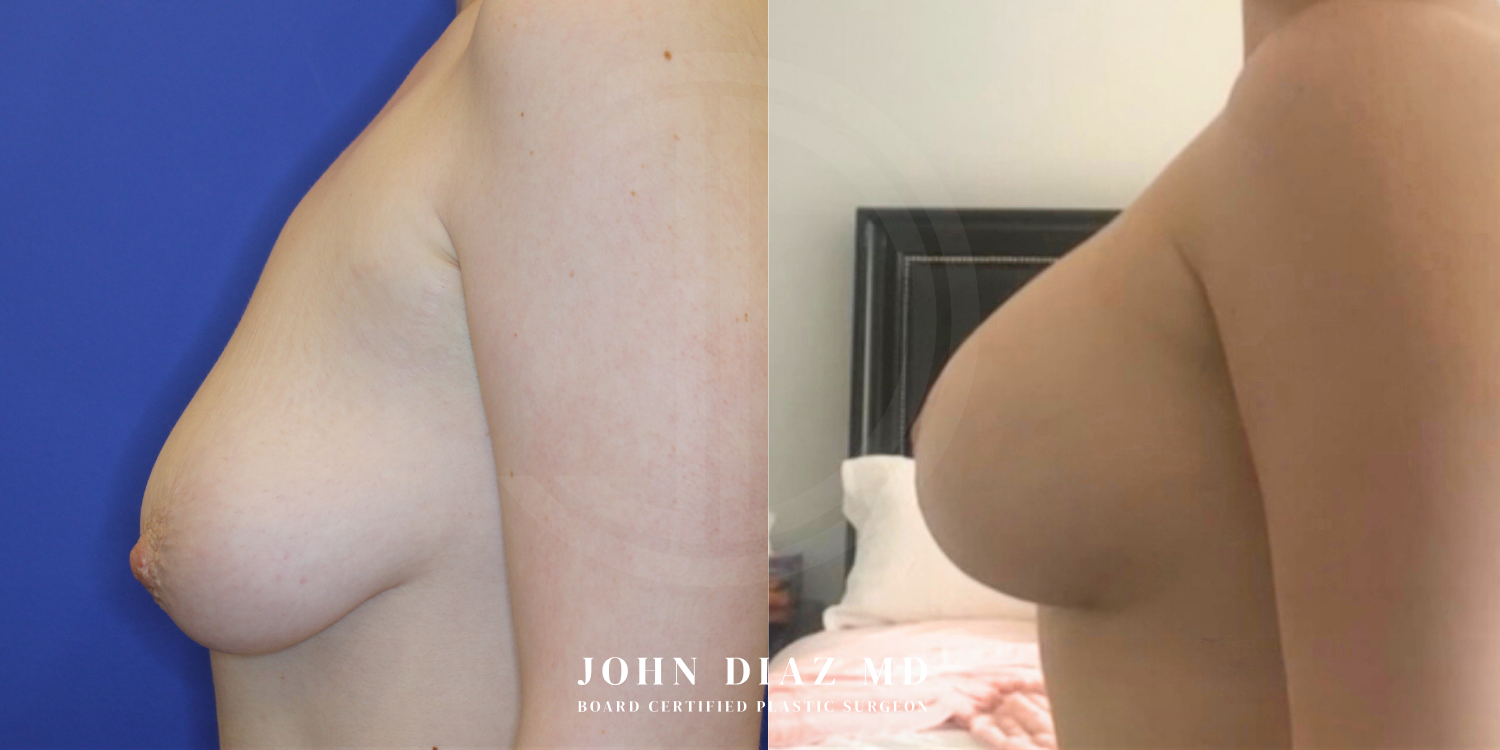 Dr John Diaz Before and After | Breast Augmentation