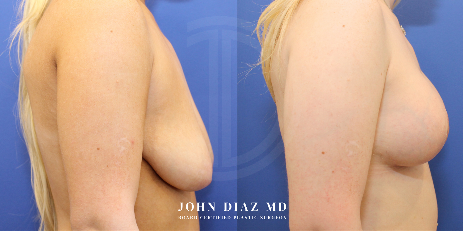 Dr John Diaz Before and After | Breast Augmentation