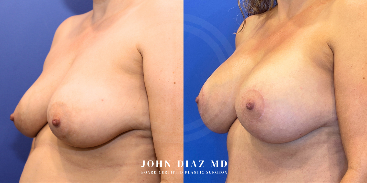 Dr John Diaz Before and After | Breast Augmentation