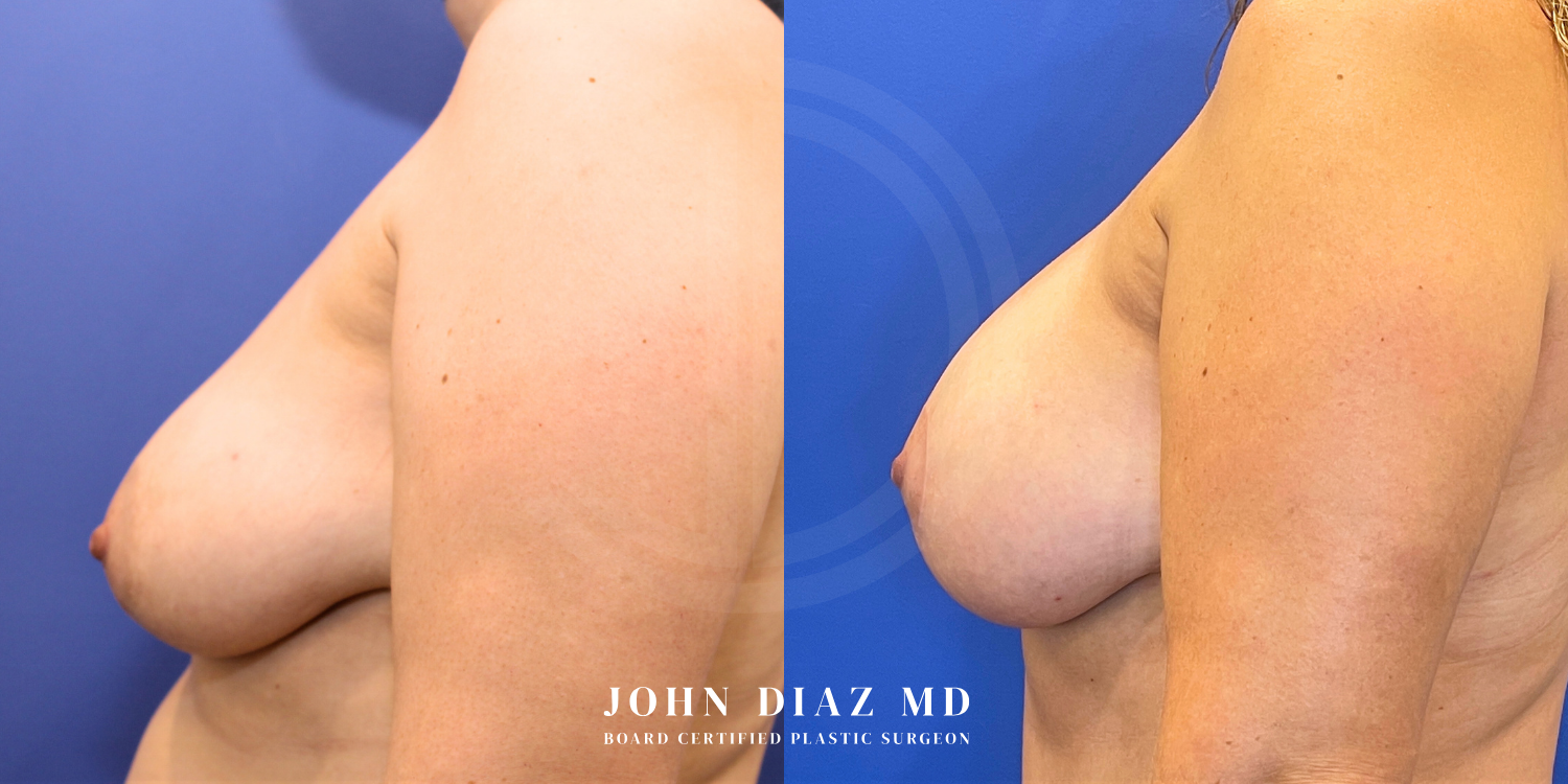 Dr John Diaz Before and After | Breast Augmentation
