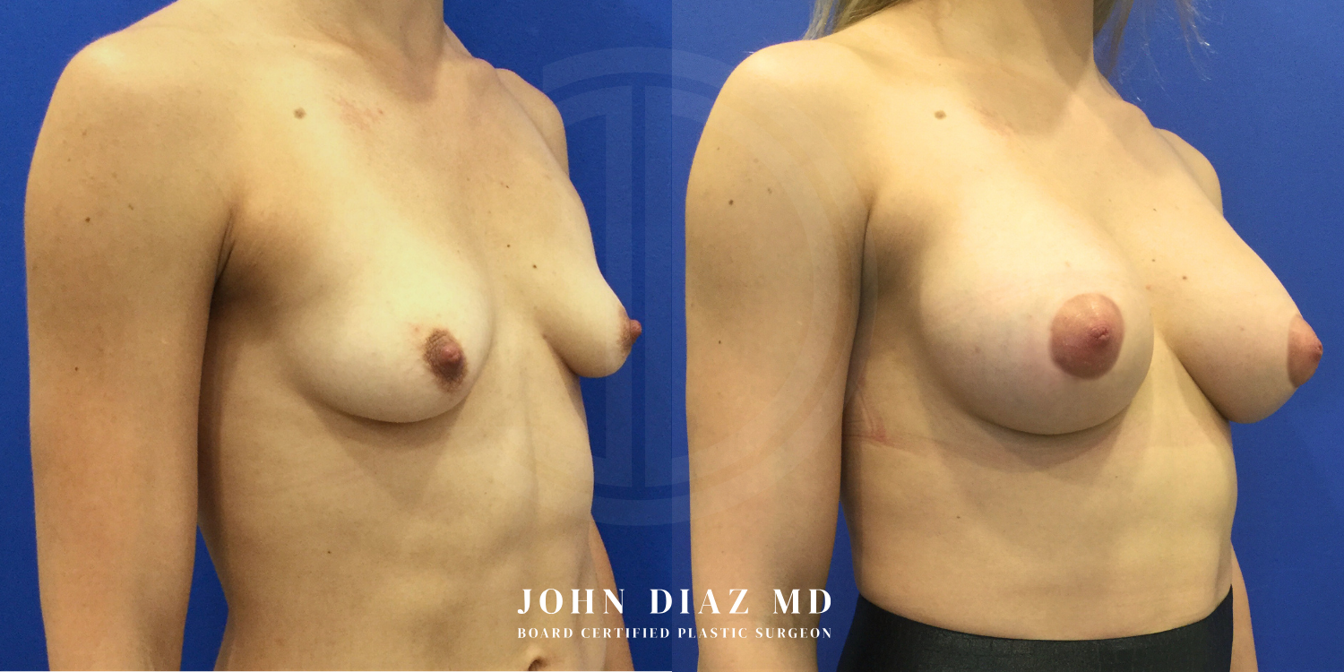 Dr John Diaz Before and After | Breast Augmentation