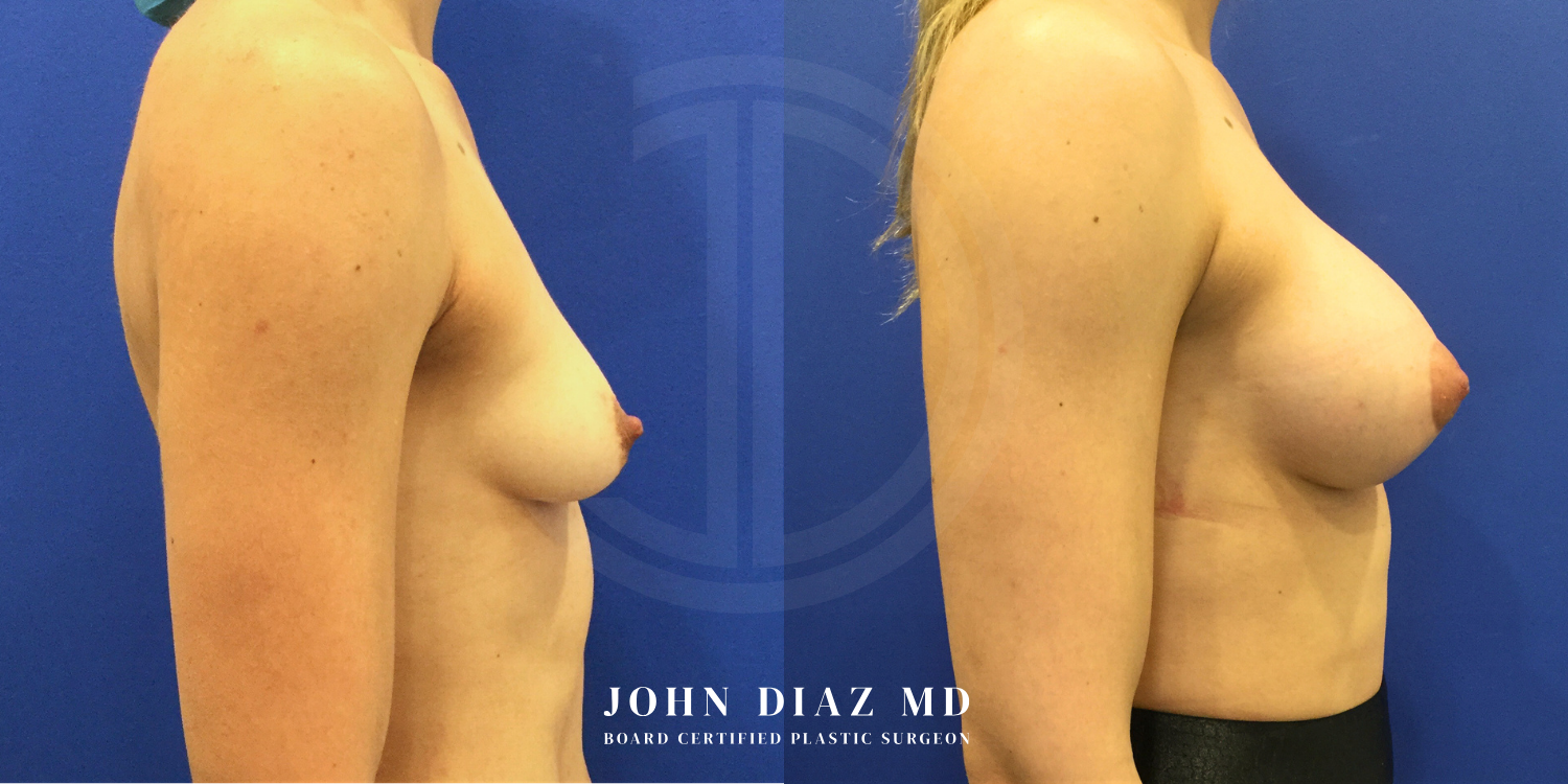 Dr John Diaz Before and After | Breast Augmentation