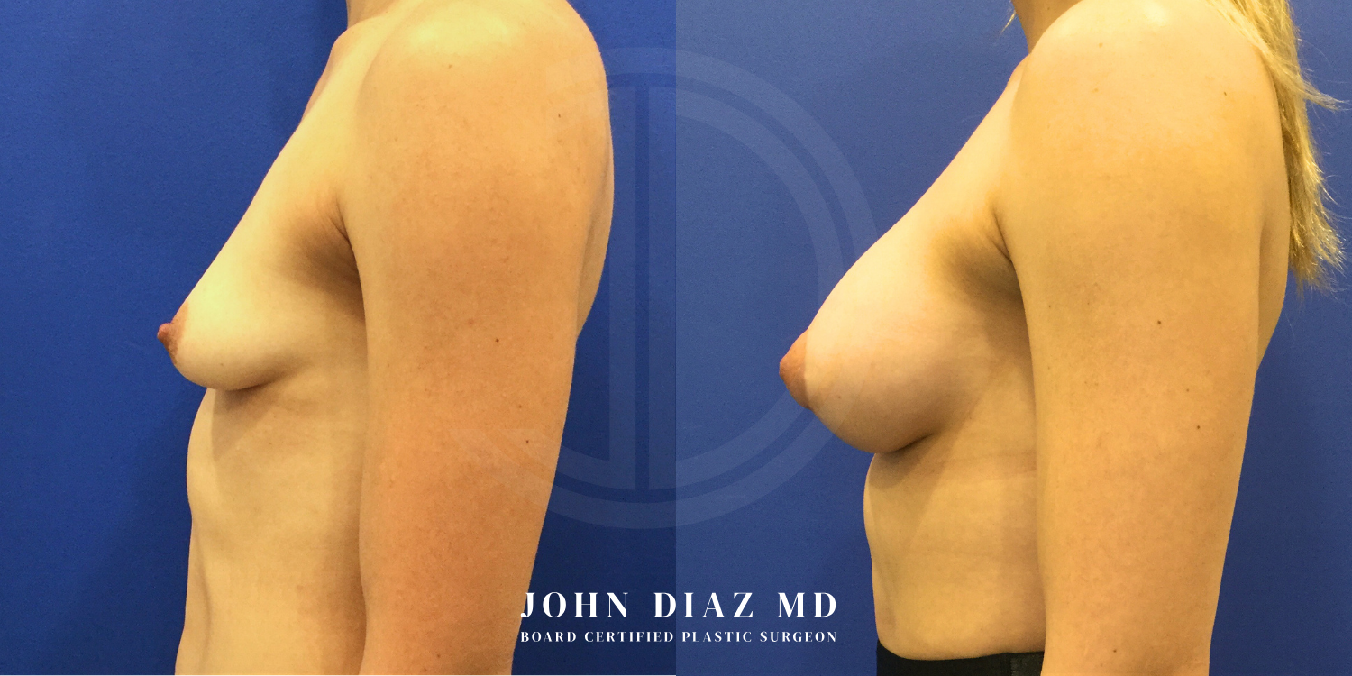 Dr John Diaz Before and After | Breast Augmentation