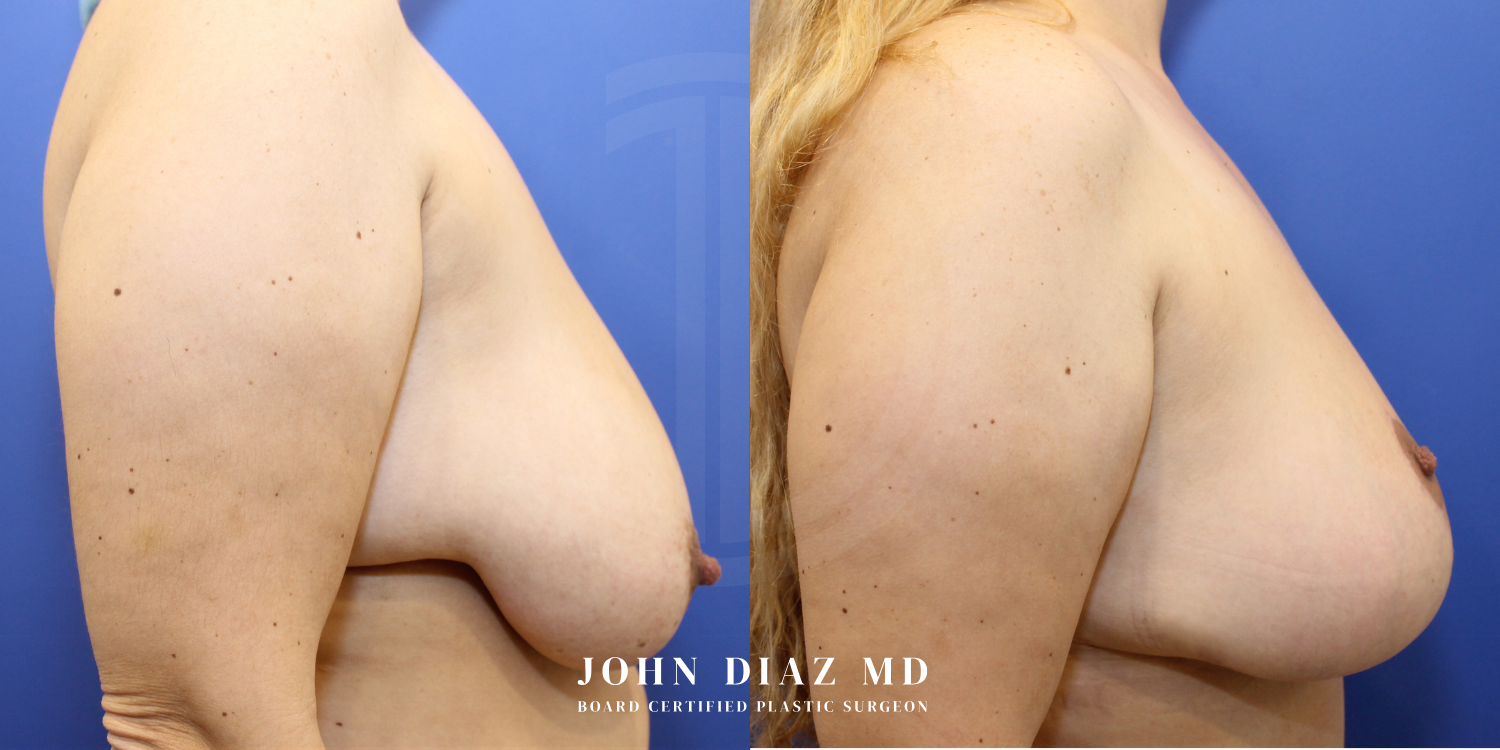 Dr John Diaz Before and After | Breast Augmentation