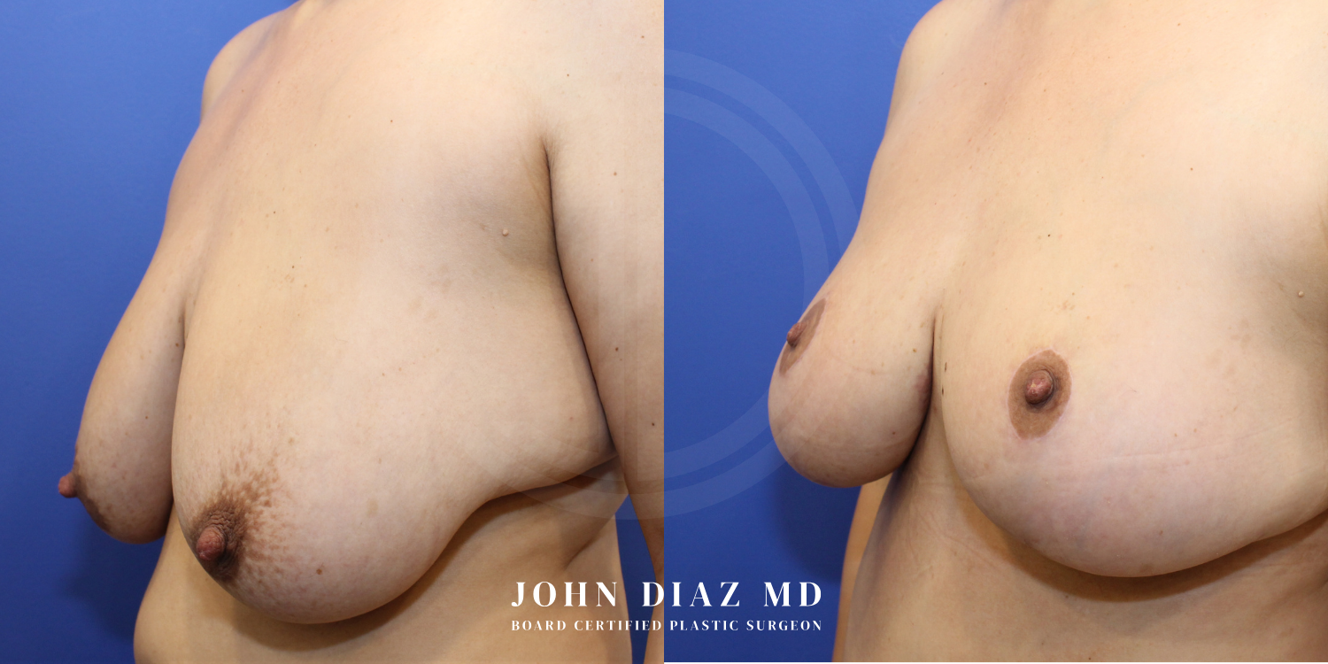 Dr John Diaz Before and After | Breast Augmentation