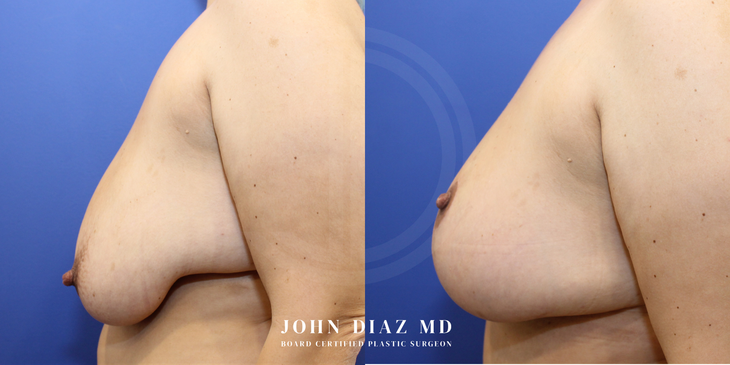 Dr John Diaz Before and After | Breast Augmentation