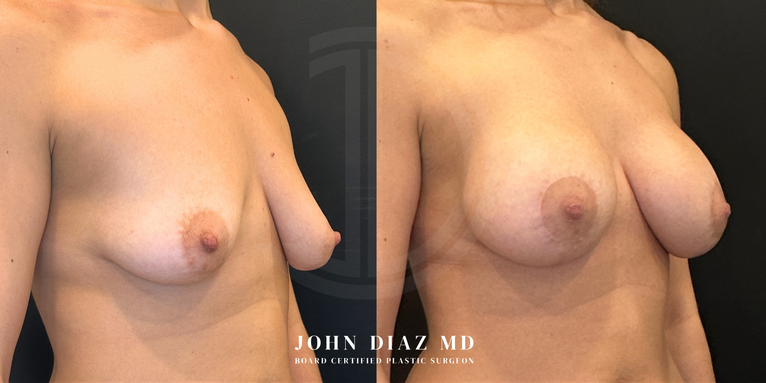 Dr John Diaz Before and After | Breast Augmentation