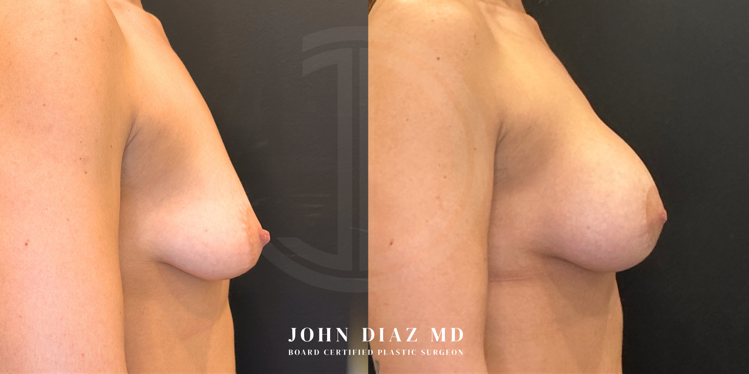 Dr John Diaz Before and After | Breast Augmentation