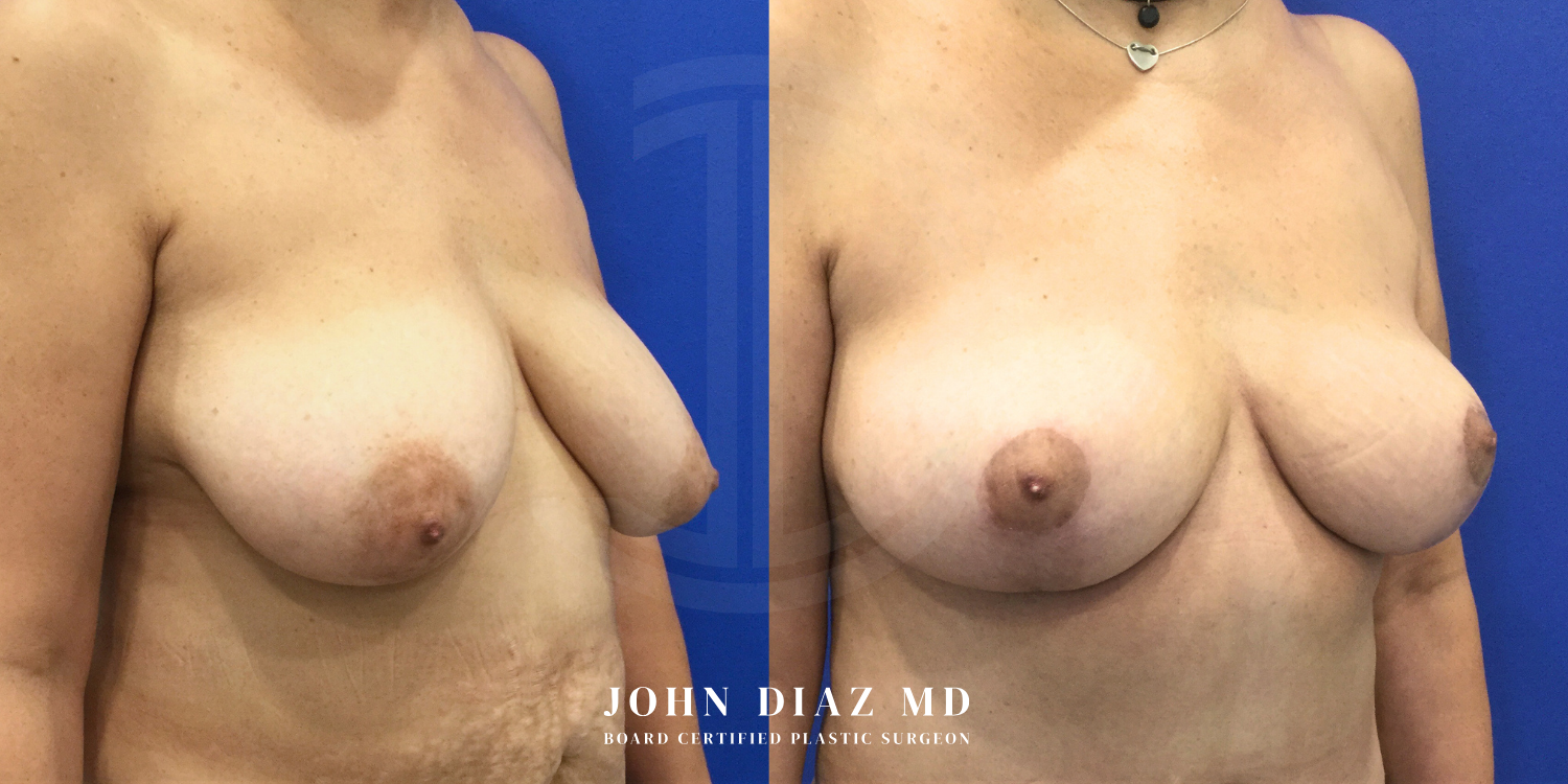 Dr John Diaz Before and After | Breast Augmentation