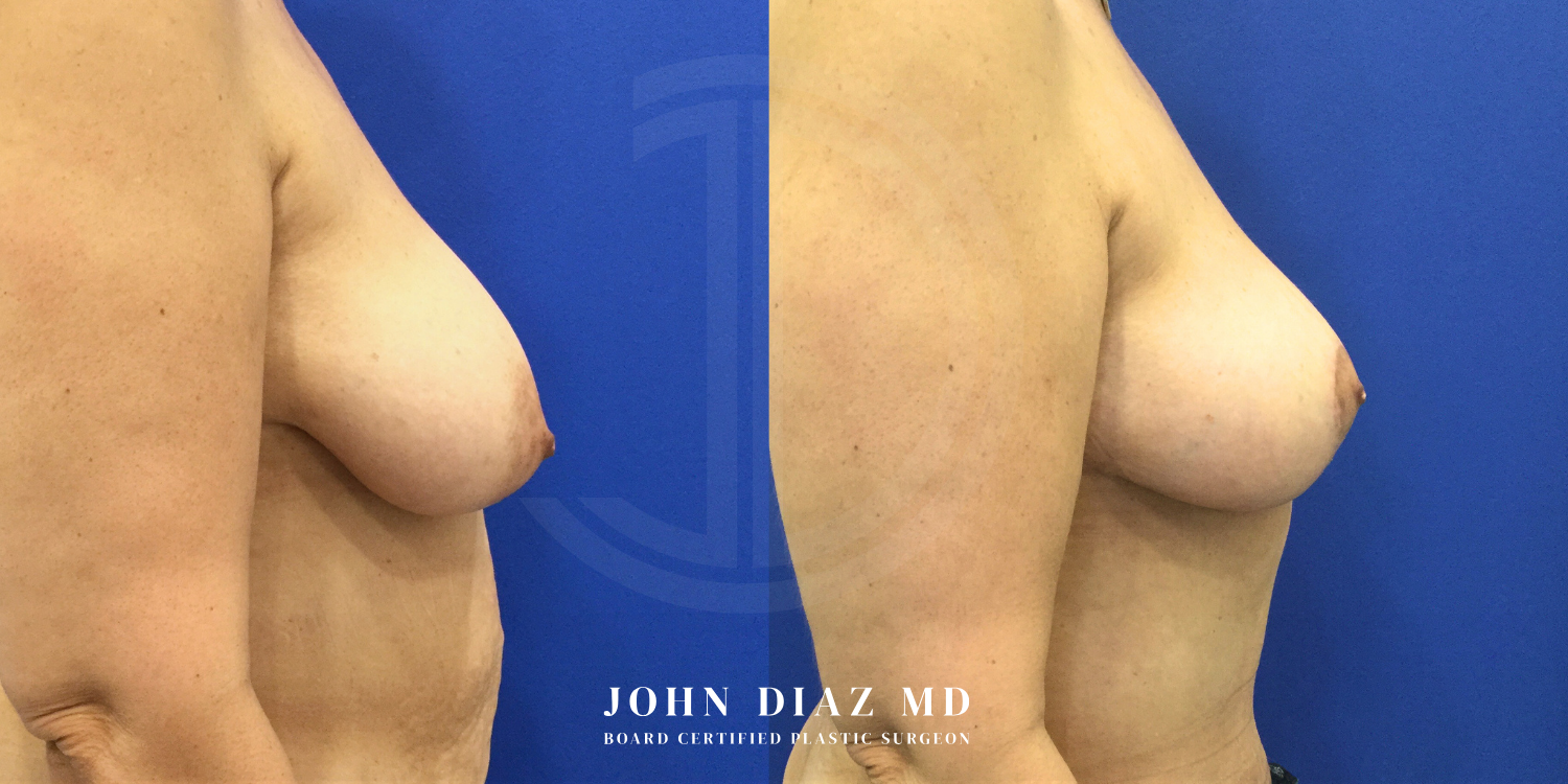 Dr John Diaz Before and After | Breast Augmentation