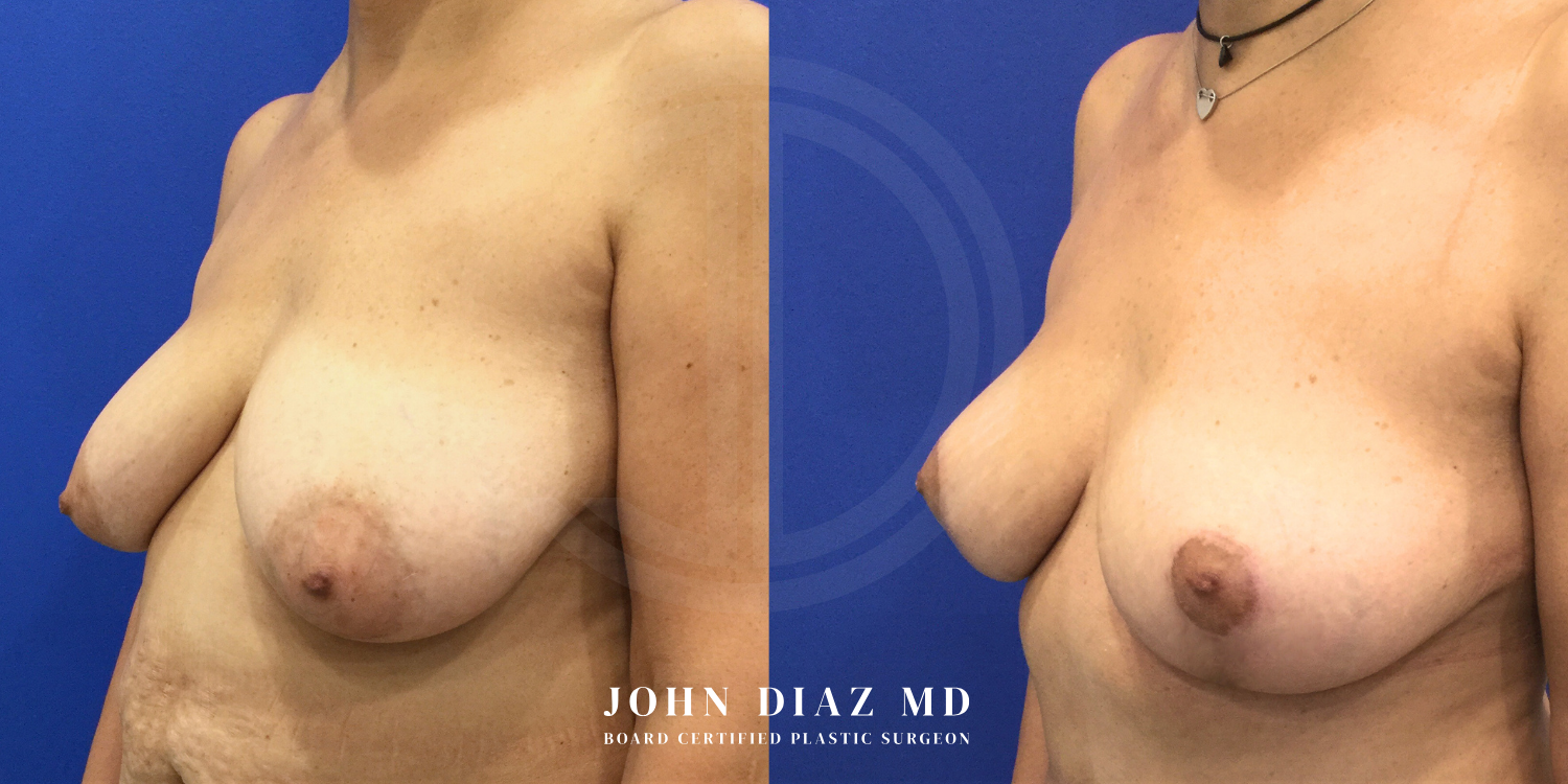 Dr John Diaz Before and After | Breast Augmentation