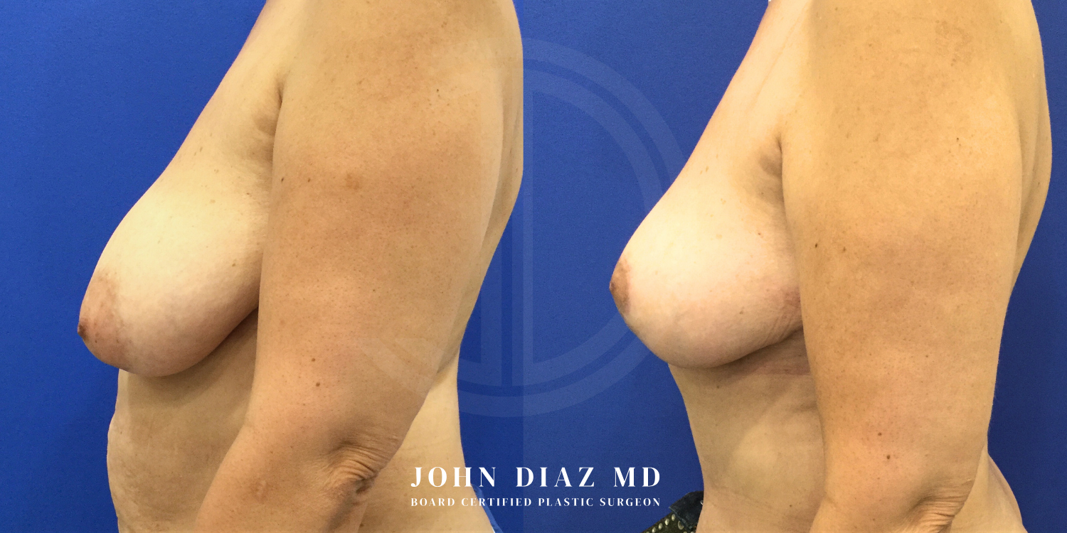 Dr John Diaz Before and After | Breast Augmentation