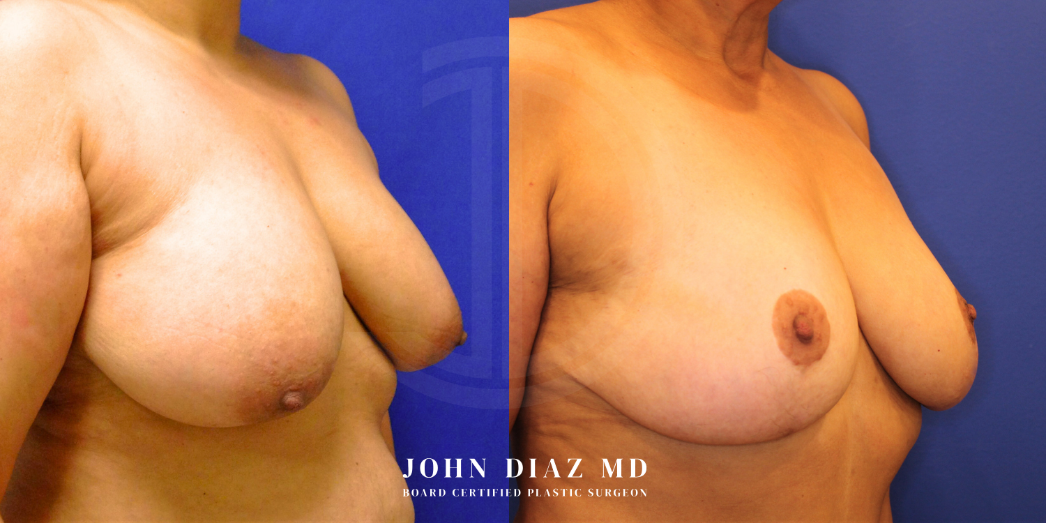 Dr John Diaz Before and After | Breast Augmentation