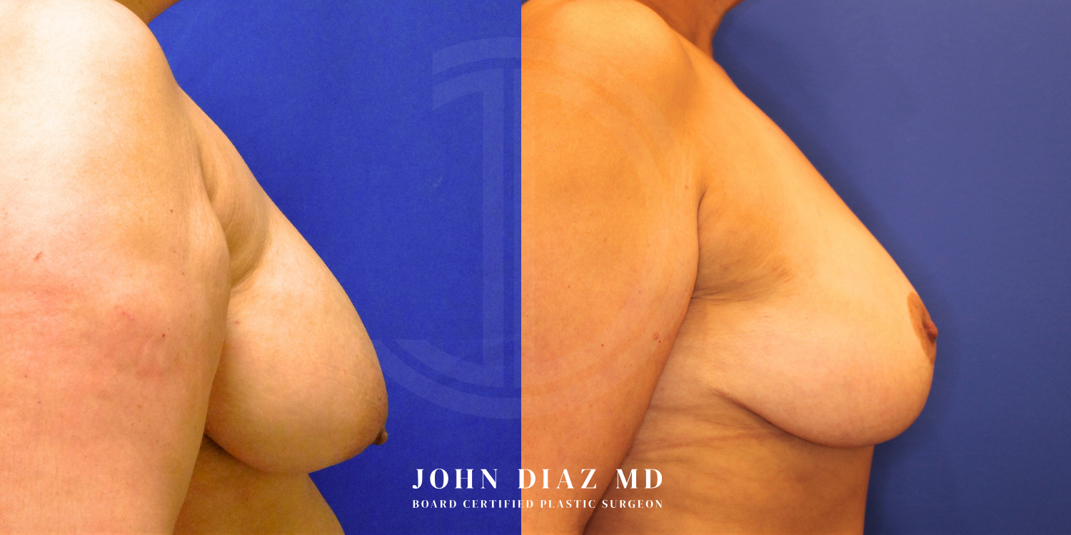 Dr John Diaz Before and After | Breast Augmentation