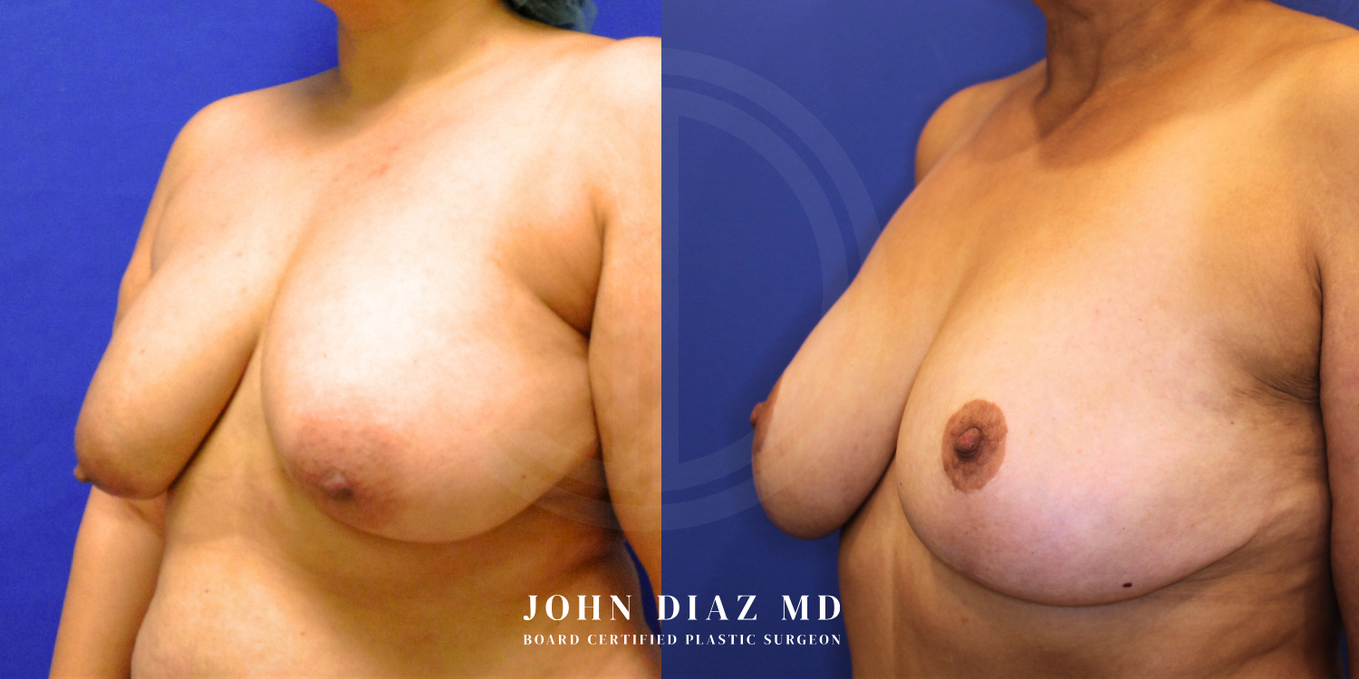Dr John Diaz Before and After | Breast Augmentation