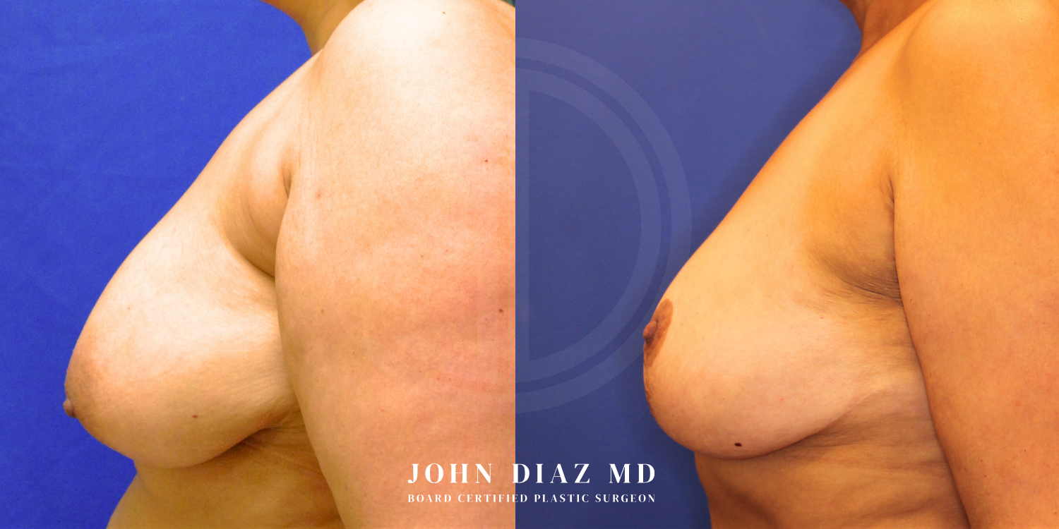 Dr John Diaz Before and After | Breast Augmentation