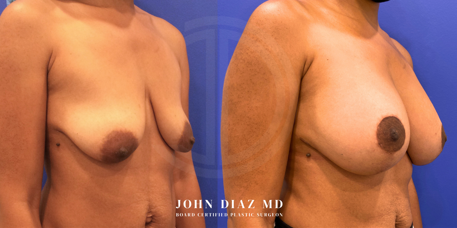 Dr John Diaz Before and After | Breast Augmentation