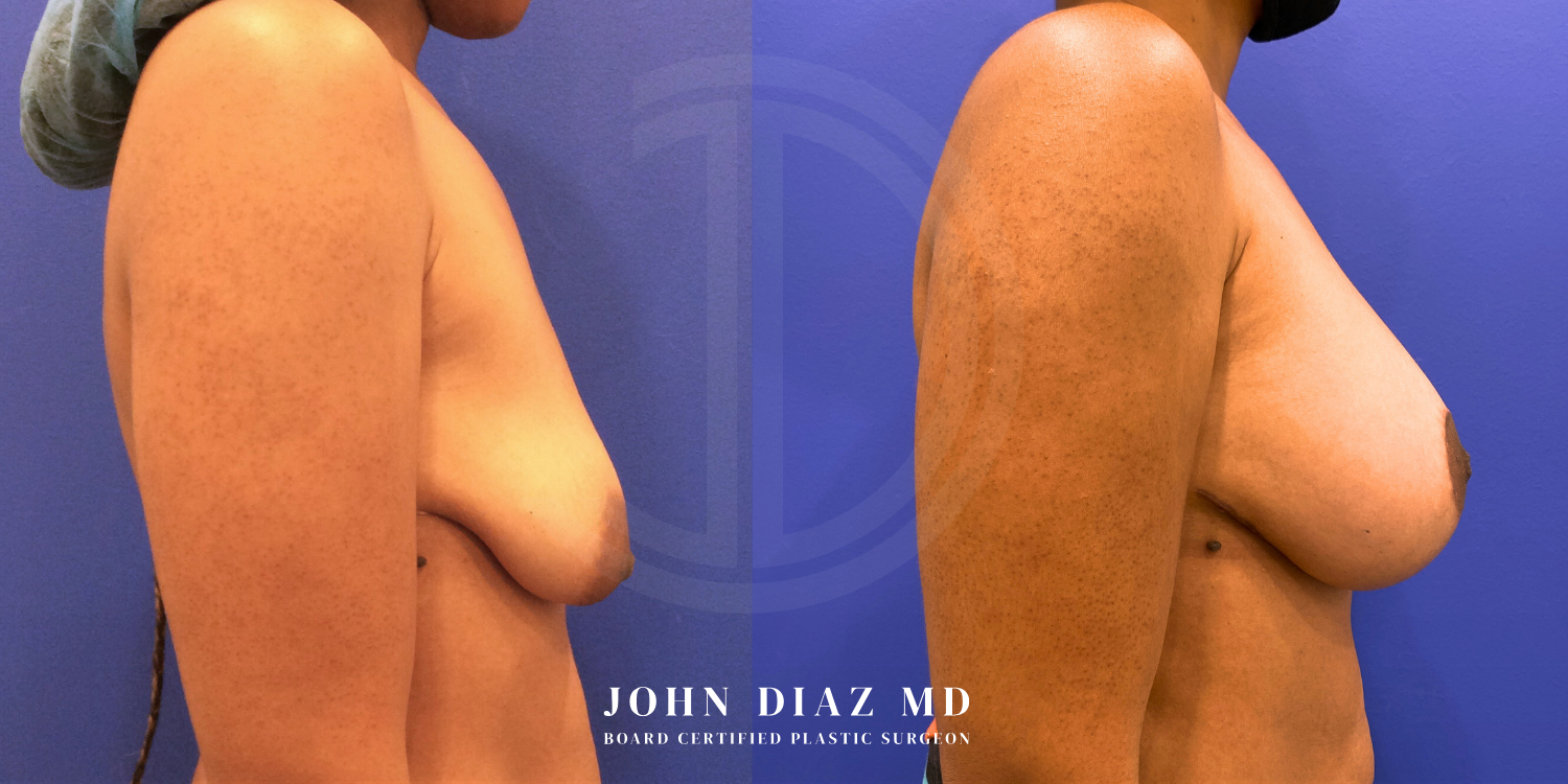 Dr John Diaz Before and After | Breast Augmentation