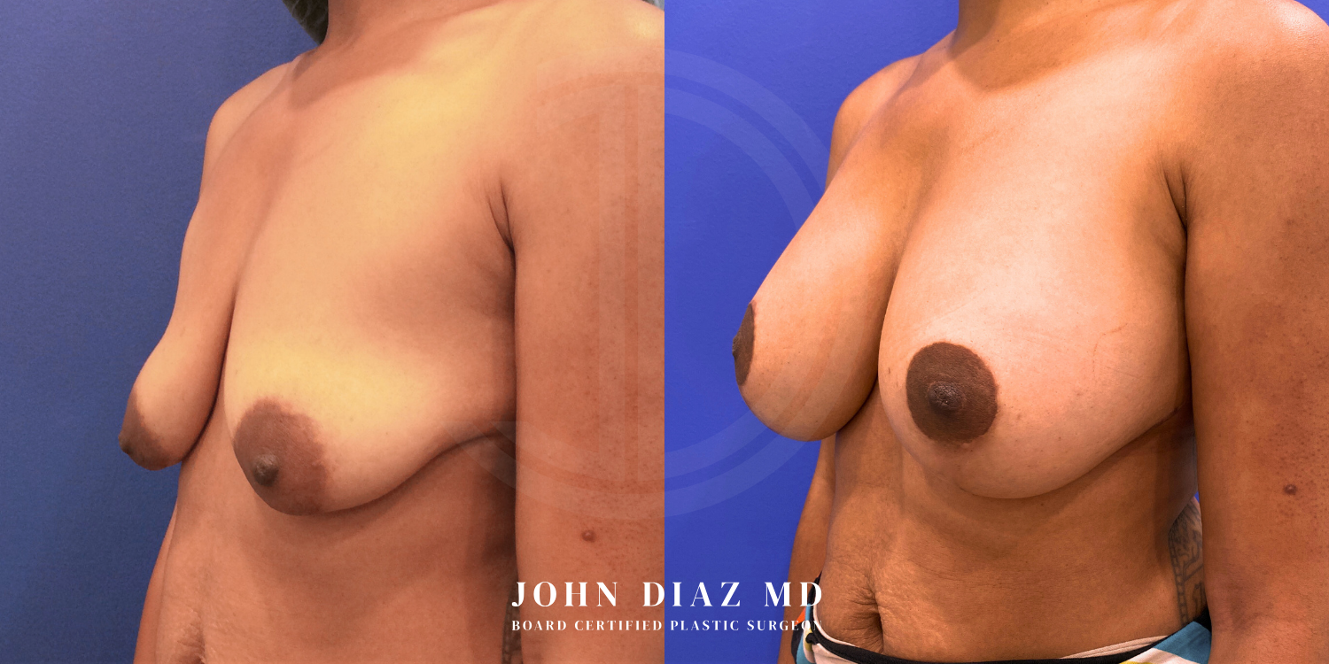 Dr John Diaz Before and After | Breast Augmentation