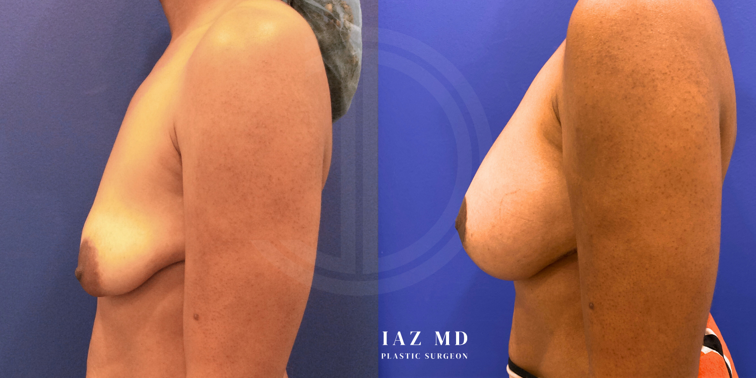 Dr John Diaz Before and After | Breast Augmentation